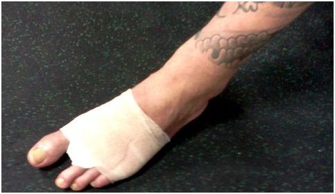 broken toe cast. a slow-healing roken toe